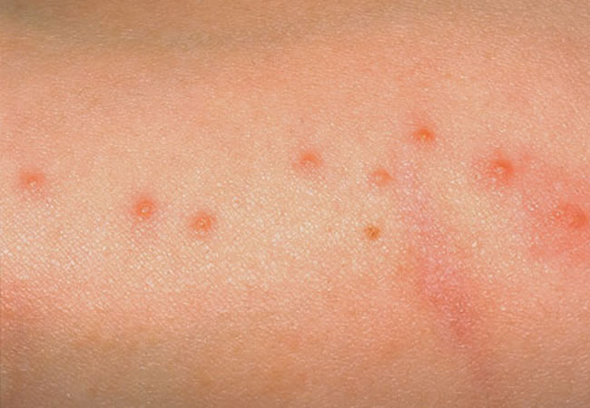 ... , neck, hands and arms are common feeding spots of bed bugs. The most